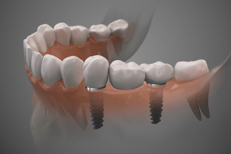 single dental implant in a clear jaw model, grey background