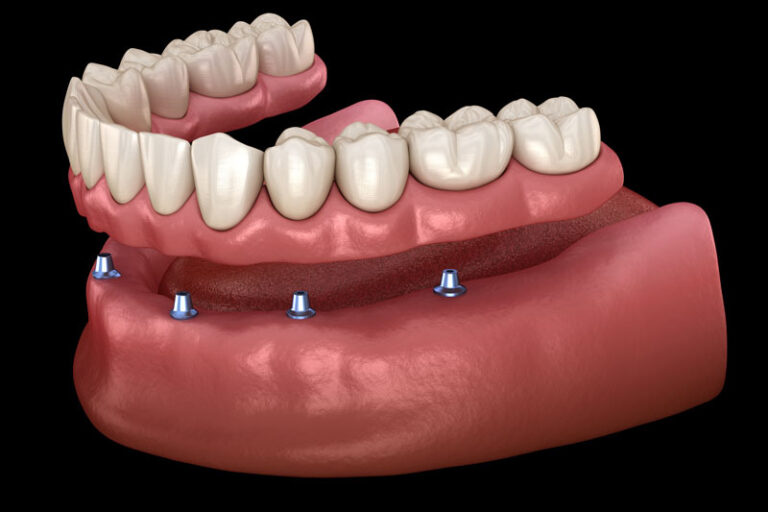 model of tooth dentures on an all on 4