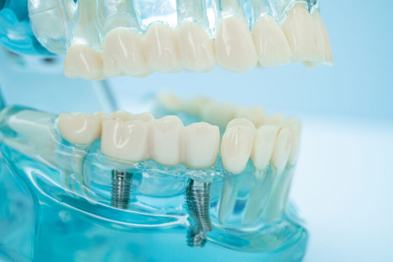 full mouth dental implant, implant solutions, blue