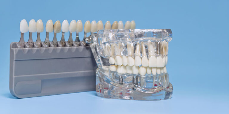 Discover how dental implants and abutments restore smiles. Learn about types, care, and expert placement for long-lasting results.