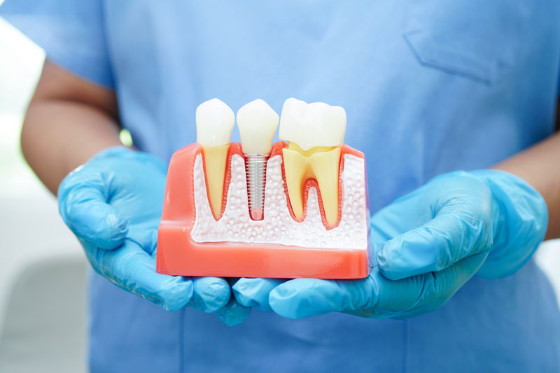 Doctor hold dental implant, artificial tooth roots into jaw, root canal of dental treatment, gum disease, teeth model for dentist studying about