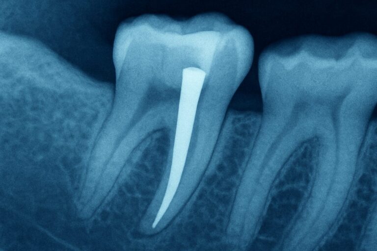 A close up x-ray showing a tooth with a post secured within the root canal, reinforcing the tooth structure. No text on image.